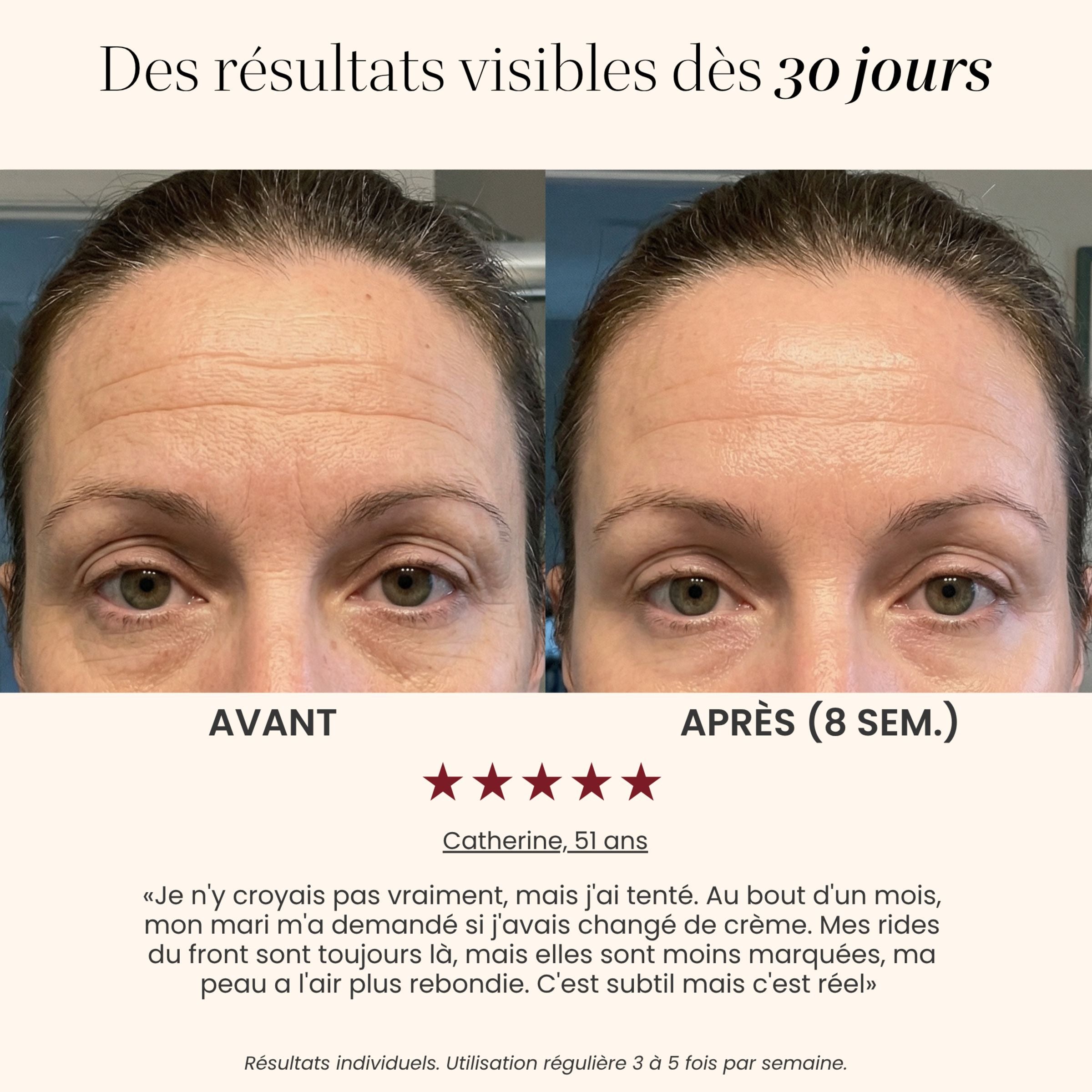 Avant / après rides du front avec le Masque LED intégral Auréa™ : front lissé après 8 semaines