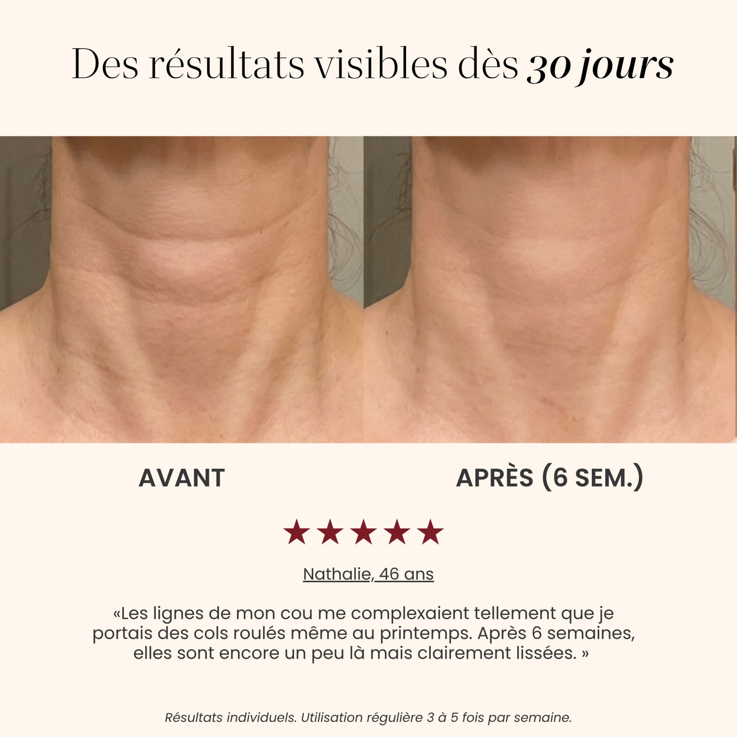 Avant / après cou avec le Masque LED intégral Auréa™ : lignes du cou visiblement lissées après 6 semaines