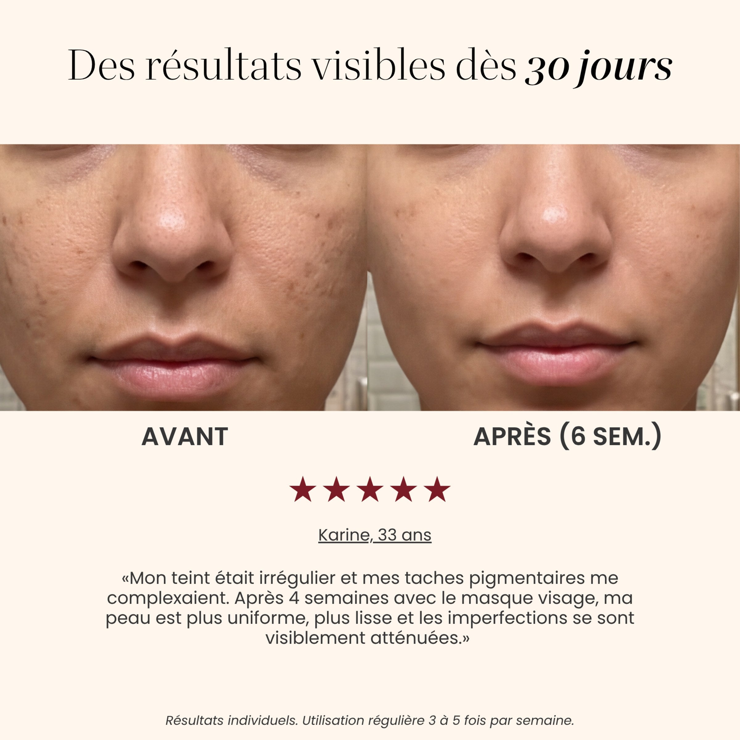 Avant / après teint et taches avec le Masque LED intégral Auréa™ : peau plus uniforme après 6 semaines