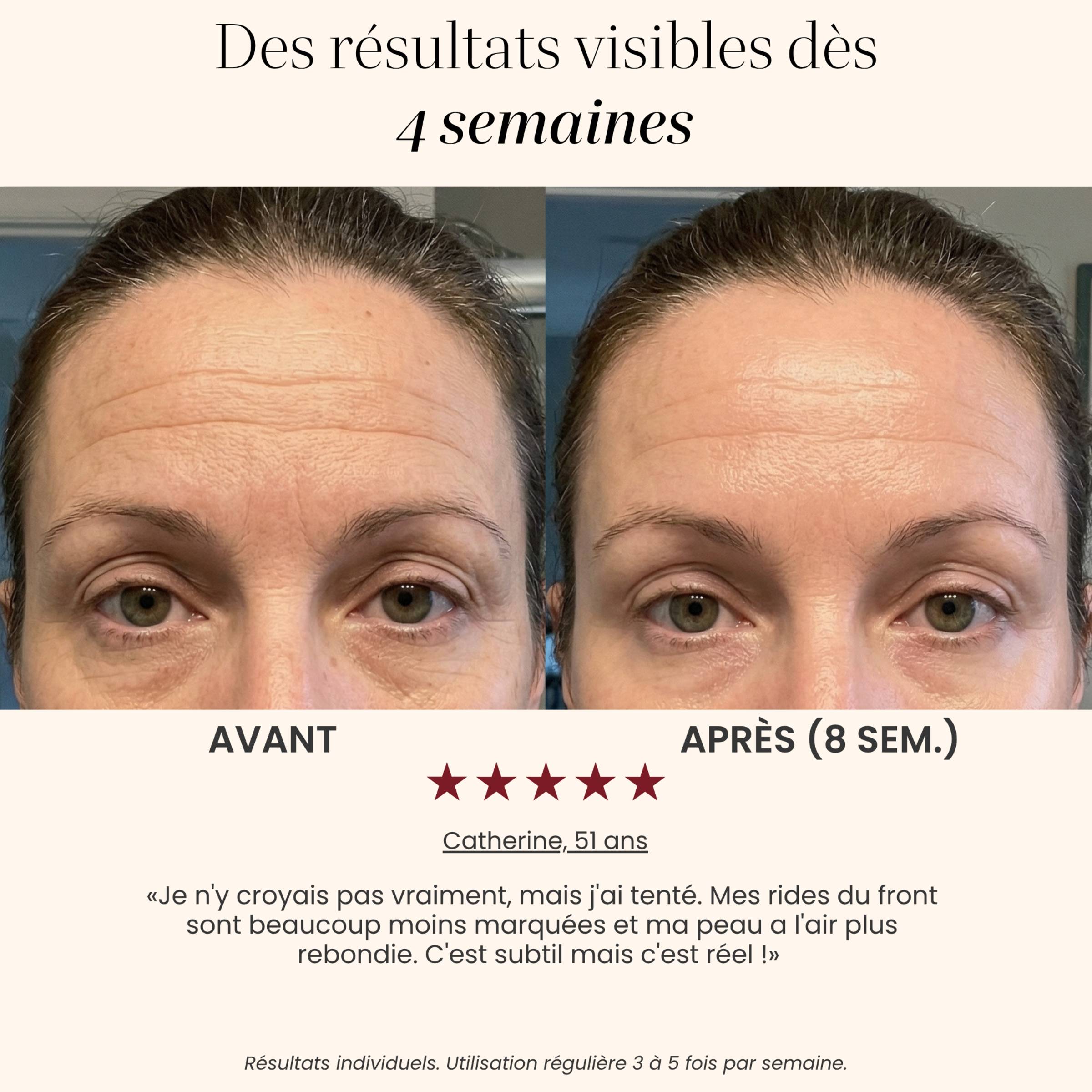 Avant / après rides du front avec le Masque LED visage Auréa™ : front lissé après 8 semaines