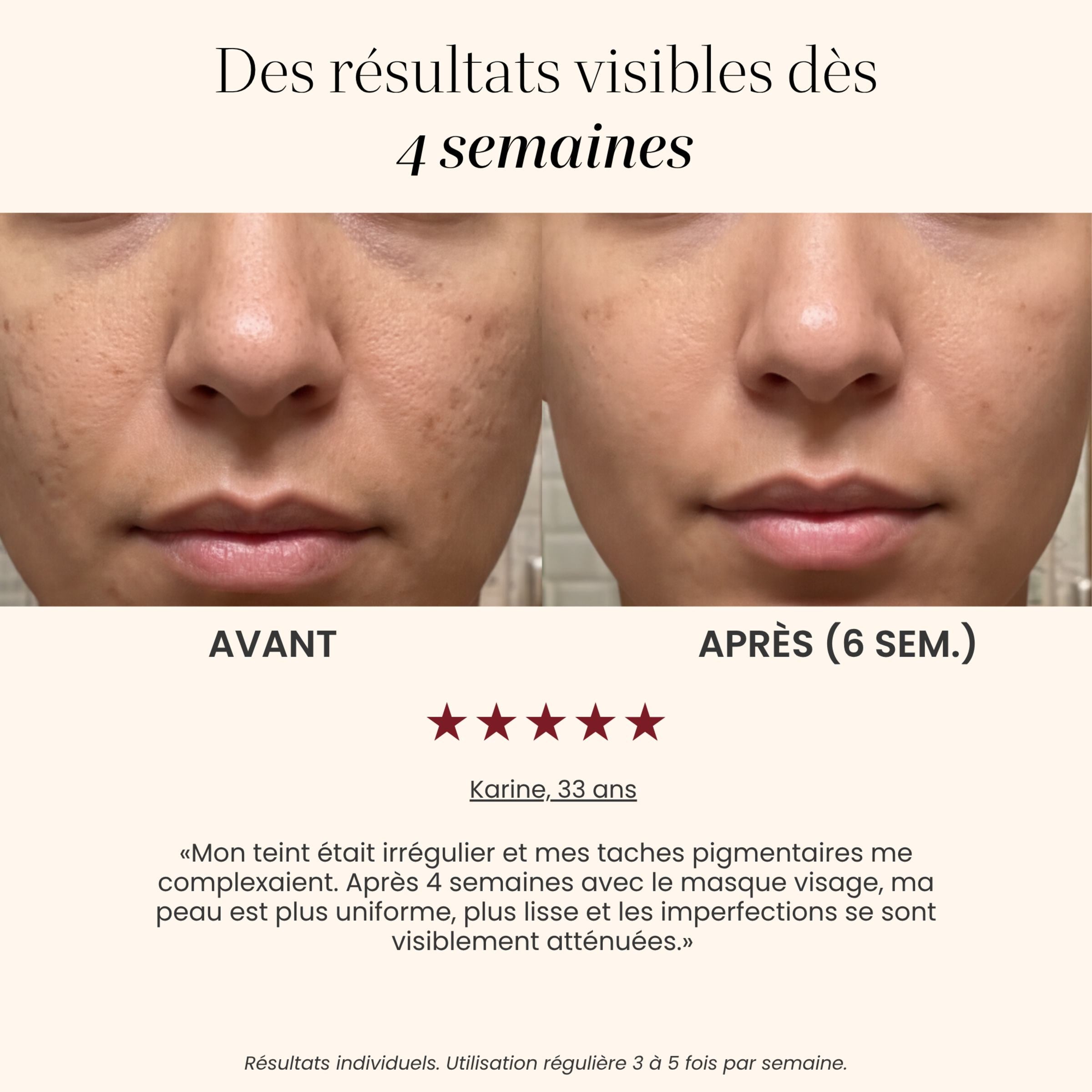 Avant / après teint et taches pigmentaires avec le Masque LED visage Auréa™ : peau plus uniforme après 6 semaines
