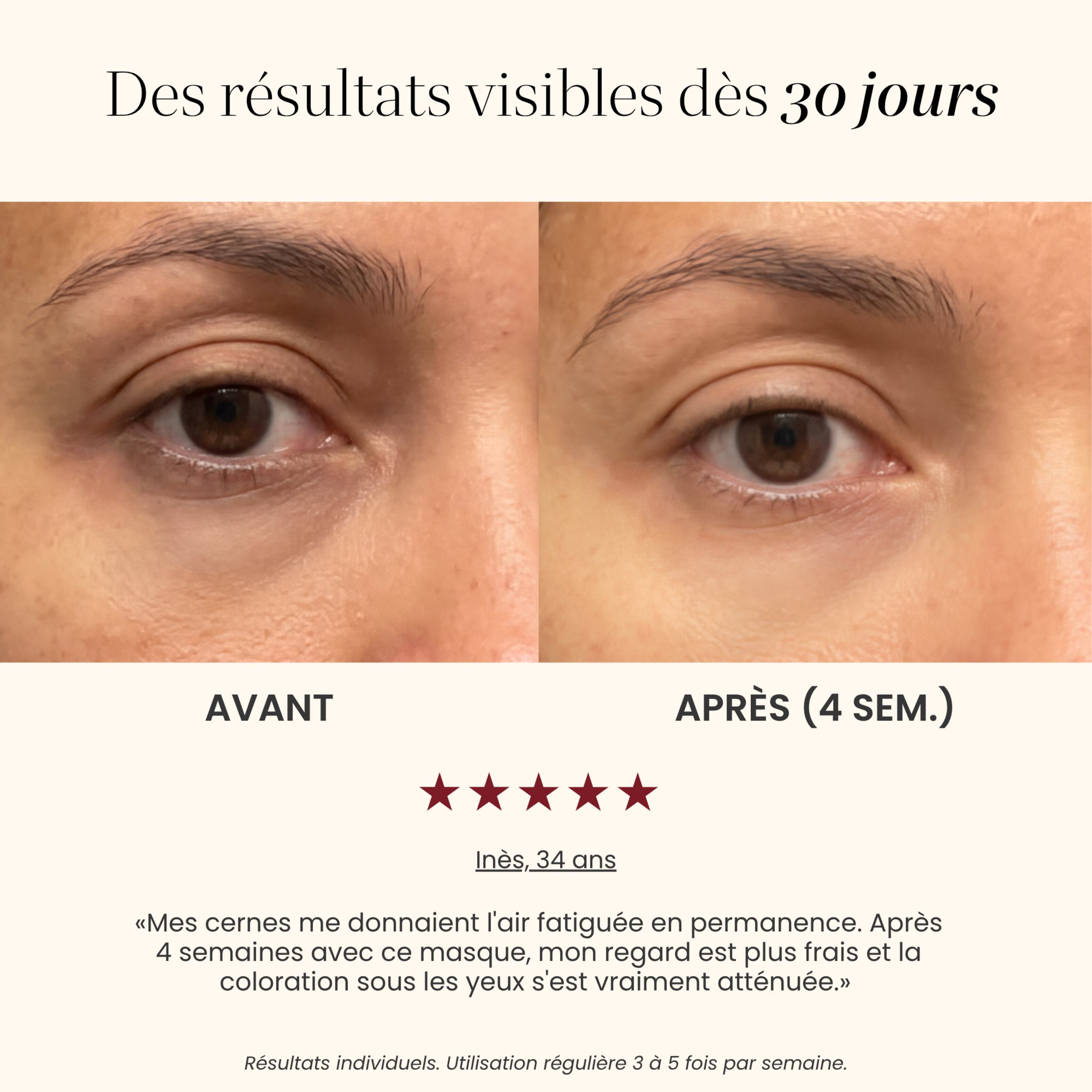 Avant / après cernes avec le Masque LED yeux Auréa™ : regard plus frais après 4 semaines