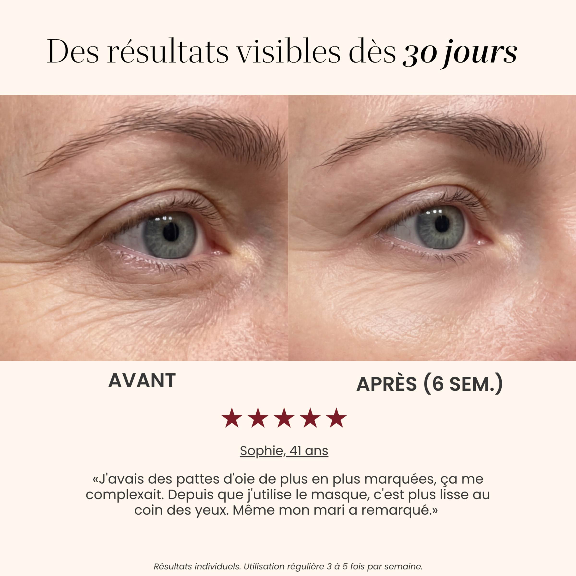 Avant / après pattes d'oie avec le Masque LED yeux Auréa™ : contour des yeux plus lisse après 6 semaines